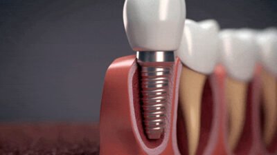 full mouth dental implants