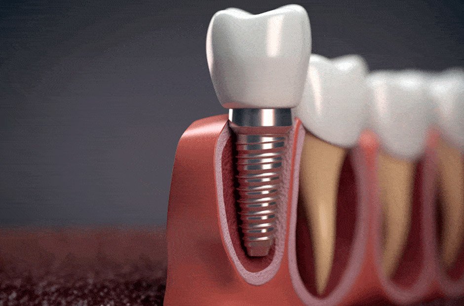 full mouth dental implants