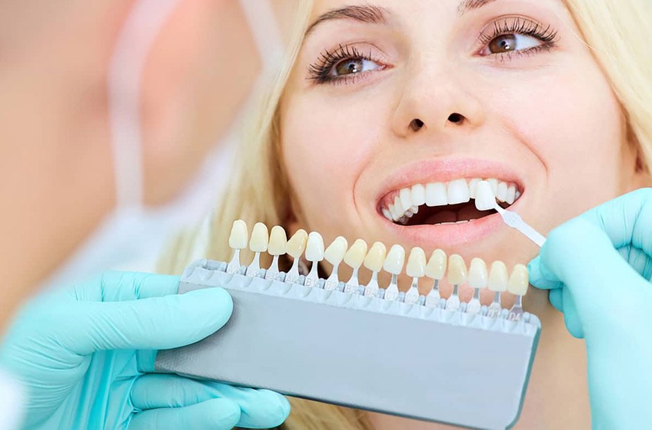 what to expect when getting porcelain veneers