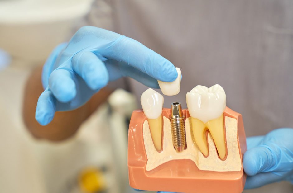 advancements in dental implant technology