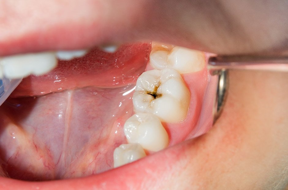 how dentists identify early signs of decay