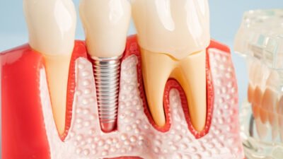 best practices for long term dental implant care