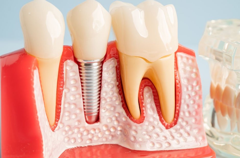 best practices for long term dental implant care