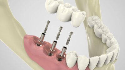 4 steps involved in the dental implant process