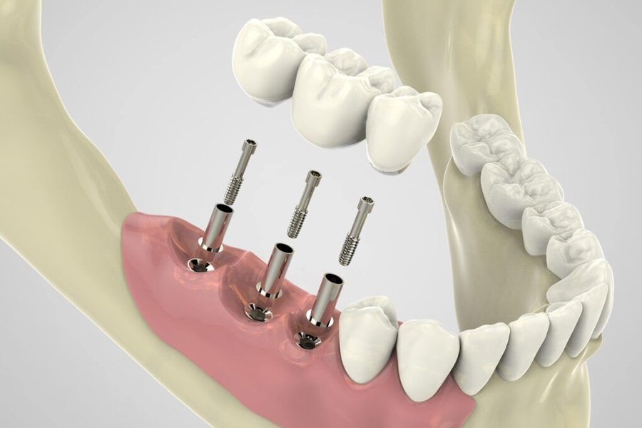 4 steps involved in the dental implant process