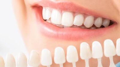 5 advantages of combining whitening with restorations