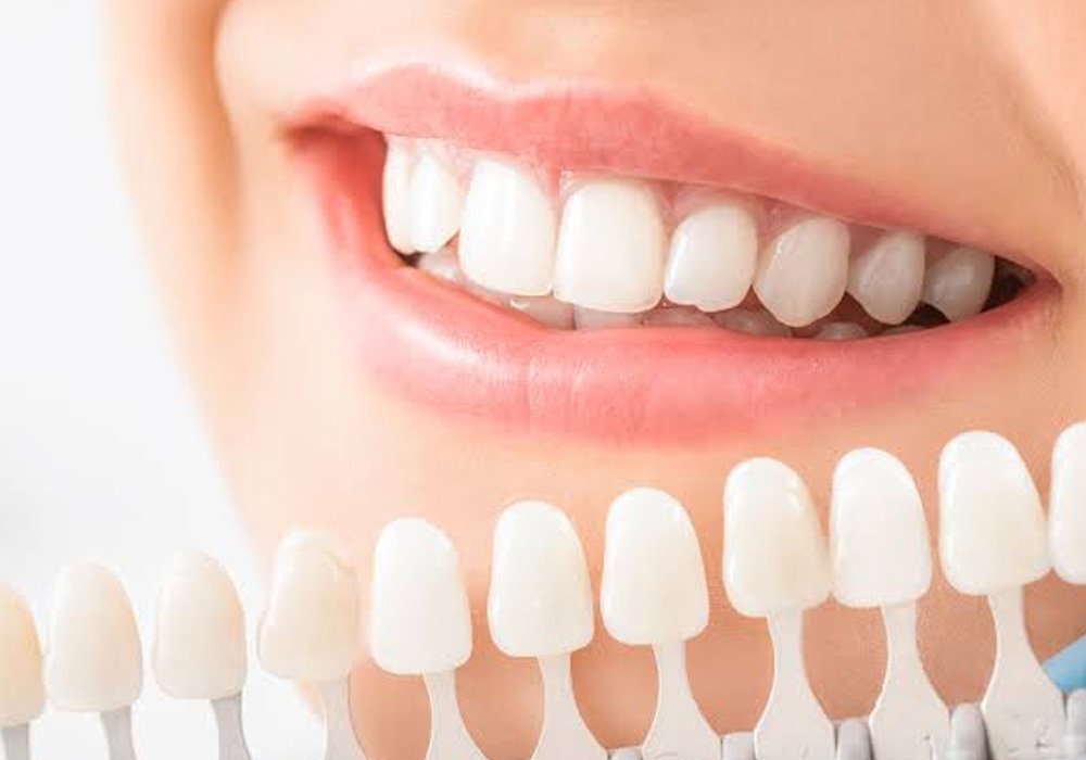 5 advantages of combining whitening with restorations